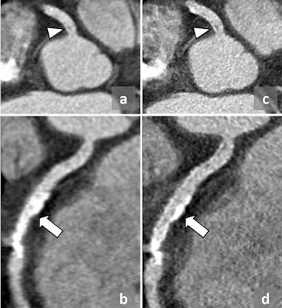 Kernel selection has an important effect on final image quality, especially in the presence of significant calcification or coronary stenting. The image on the left shows a curved multiplanar reformat of a stented coronary artery reconstructed using a medium-smooth kernel. This results in significant blooming artifact and precludes adequate diagnostic assessment. Reconstructing the same dataset using a medium-sharp kernel reduces stent blooming and allows assessment of the stent lumen.