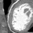 2011 06 30 10 01 53 475 2011 06 30 Cardiact Ct Image1 Thumb