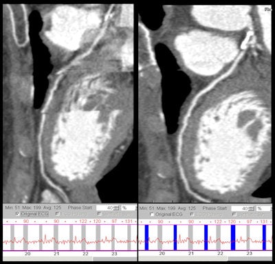 The effect of poor-quality ECG amplitude is seen on the left image, with clear artifact compromising image quality. The R and T waves are of equal amplitude, resulting in images derived from imaging data combined from two separate phases of the cardiac cycle. Editing the ECG gating (right) so that only one phase from each cardiac cycle is used to reconstruct the images largely eliminates the artifact. All images courtesy of Dr. James Stirrup.