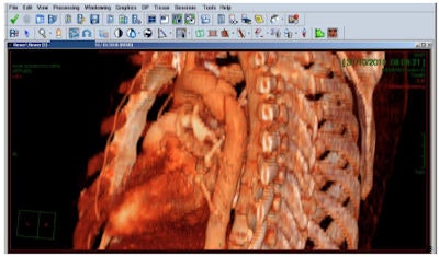 Using PACS, doctors were able to save the life of a 40-year-old patient following a road traffic accident. CT angiography at Meir Medical Center (level II trauma) demonstrated a contained traumatic rupture of the aorta — a life-threatening condition. Meir emergency room doctors consulted the cardiothoracic unit in Rabin Medical Center (level I trauma) using the PACS. Both groups were able to view in real-time the CT study containing 2,000 images (1,000 MB of imaging data). The advanced visualization tools embedded in the PACS made it possible to complete the diagnosis and surgical planning in minimal time. The images show maximal intensity projection (MIP) and volume rendering (VR) of the ruptured aorta.