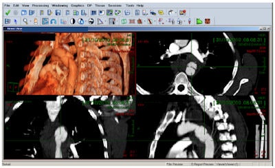Maximal intensity projection and volume rendering of ruptured aorta