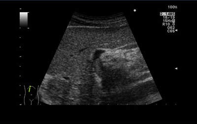 A distinct tumor plug is seen in the portal vein. Intraoperative ultrasound enables surgeons to remove the lesion without damaging too much of the surrounding healthy tissue. Image courtesy of Aloka.