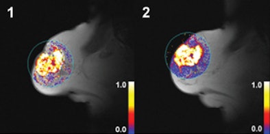MR of grade 2 carcinoma