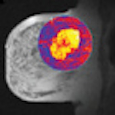 2011 07 06 16 04 57 96 Li Mri Breast Thumb