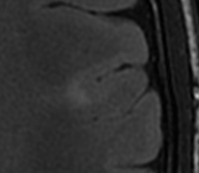 Blurring of the grey matter-white matter interface on an axial FLAIR sequence corresponding to a focal cortical dysplasia in a patient with epilepsy.