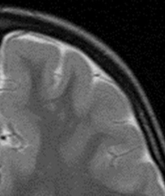 Cortex-isointense signal abnormalities in the subcortical white matter on T2-weighted axial sequence corresponding to heterotopia.