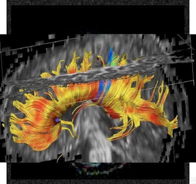 Diffusion-weighted imaging is proving valuable in cases of suspected ischemia. Diffusion-tensor imaging (DTI) involves fiber tracking and can evaluate the degree of anisotropy and maturation processes. All images courtesy of Dr. Birgit Ertl-Wagner.
