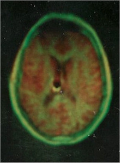 Figure 3: Early NMR of human head, 1980 (EMI). Image obtained with polar reconstruction similar to CT. The later images were improved by using the Cartesian (phase delay) reconstruction, as used today. Image courtesy of the archives of the British Institute of Radiology.