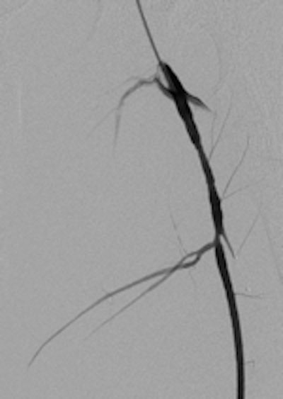 A 19-year-old male with delayed presentation following gunshot injury in the thigh. Left: T1 coronal MRI shows a large pseudoaneurysm in the upper thigh. Pre- (middle) and postembolization (right) angiographic images demonstrate successful treatment of the pseudoaneurysm.