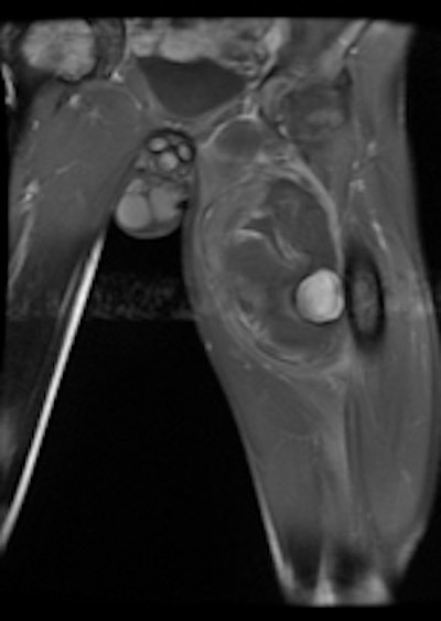MR image of gunshot wound