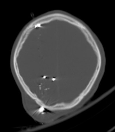 A 30-year-old male with a gunshot wound to the head. Left: Brain window axial CT image demonstrates a significant soft-tissue swelling and underlying fracture at the entry site of the projectile. The course of the bullet is seen by a linear hemorrhage through the right cerebral hemisphere. There is loss of the grey-white differentiation in keeping with a diffuse hypoxic injury. Right: The fragmentation and scatter of the low-velocity projectile is best seen on CT bone windows. All images courtesy of Dr. Andrew Shawyer.