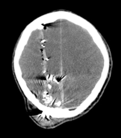 Axial CT image of gunshot wound