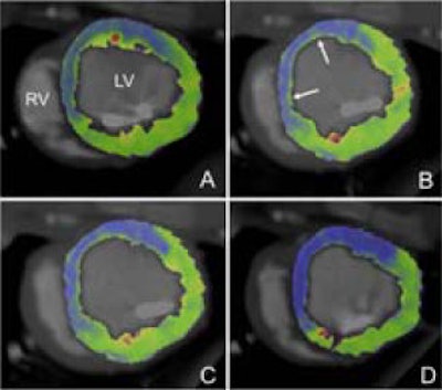 Myocardial blood flow at rest (A and C) and at stress (B and D) in the animal study. Image courtesy of Dr. Konstantin Nikolaou.