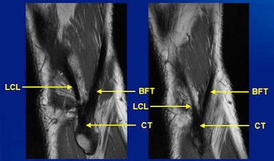 3-tesla MRI clearly shows detailed anatomy of the biceps femoris tendon, the conjoint tendon, and the lateral (fibular) collateral ligament in the posterolateral corner. All images courtesy of Dr. Edwin Oei.