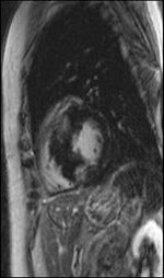 Late gadolinium enhancement shows focal myocardial fibrosis. All images courtesy of Dr. Daniel Theisen.