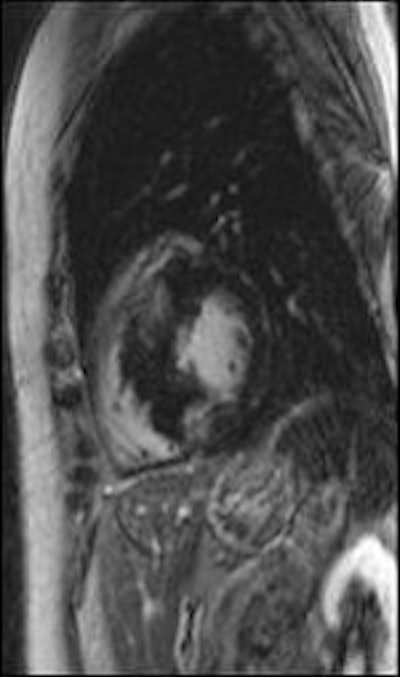 Late gadolinium enhancement shows focal myocardial fibrosis. All images courtesy of Dr. Daniel Theisen.
