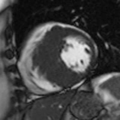Cine MRI in short axis orientation in a patient with hypertrophic cardiomyopathy.