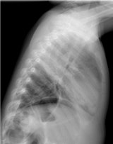 A 4-year-old boy presenting with fever and tachypnea. Left: Chest x-ray antero-posterior view. Right: Lateral view reveals an opacity without volume reduction in the right upper lobe, consistent with lobar pneumonia.