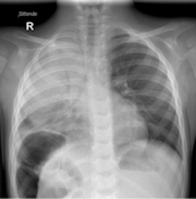 Chest x-ray of 4-year-old