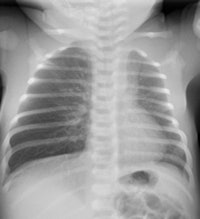 Chest x-ray of 2-week-old baby