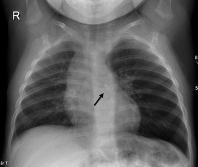 A 1-year-old girl presenting with breathing difficulties after playing with sand. Chest x-ray shows hyperinflation of the left lung and mediastinal shift to the right caused by a check valve mechanism of a small stone (black arrow) visible in the left main bronchus. All images courtesy of Dr. Charlotte de Lange.