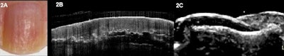 2011 07 29 12 21 57 357 2011 07 29 Psoriasis