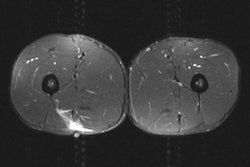 Un esprínter de 28 años sintió comienzos de dolor en la parte posterior de la pierna durante una carrera. Había evidencia de hinchazón, dolor y fuerza reducida. Una imagen por RM demostró un esguince miotendinoso grado II en la porción larga del músculo bíceps y un esguince miotendinoso grado I en el músculo recto del fémur derecho asociado con cicatriz del tendón central. Los indicadores de pronóstico fueron la longitud craniocaudal, porcentaje de participación del área transversal del músculo, presencia de una cicatriz asociada y desgarros distales versus proximales. El diagnóstico clínico fue un esguince del tendón de la corva. Todas las imágenes son cortesía del Dr. Jeremiah C. Healy.
