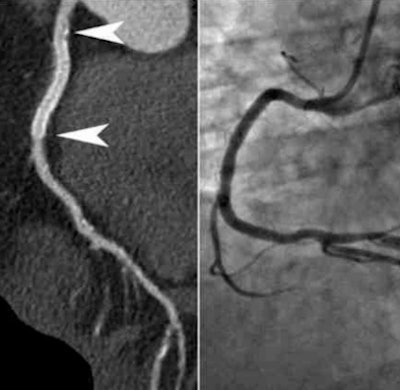 2011 07 26 13 20 06 526 Ho Stent Highpitch 394