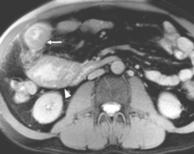 A 56-year-old patient with Crohn's disease presented with a worsening clinical condition spanning three months. Active Crohn's disease was suspected clinically. MR enterography axial fat-saturated true-FISP image demonstrates circumferential irregular small bowel wall thickening -- tumor with adjacent fat infiltration (white arrow) and prestenotic bowel dilatation (arrowhead). MRI findings demonstrated a small bowel primary tumor as a cause of the symptoms; histopathology revealed adenocarcinoma. There was no evidence of active Crohn's disease.