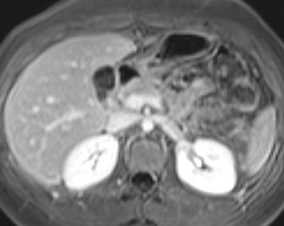 An 18-year-old female patient complained of abdominal pain, and Crohn's disease was suspected. Top: MR enterography axial fat-saturated true-FISP image demonstrates a target-like small bowel appearance of a small bowel intussusception in the left upper quadrant (white arrow). Bottom: Axial fat-saturated VIBE image after intravenous contrast medium acquired 6 min later at the same level shows no evidence of intussusception. A diagnosis of a transient small bowel intussusception was made. No evidence of Crohn's disease..