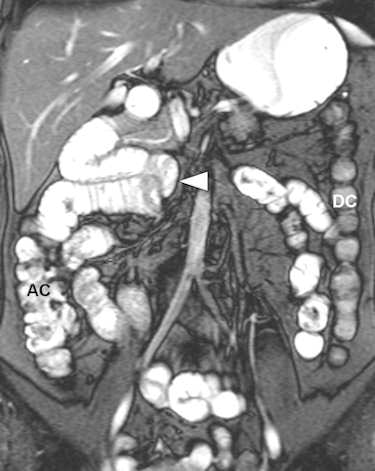 A 37-year-old female patient presented with chronic abdominal pain and was suspected of having irritable bowel syndrome. MR enteroclysis coronal fat-saturated true-FISP image demonstrates the duodenojejunal junction and proximal jejunum loops located on the right-hand side of the abdomen (arrowhead) and the normal position of the ascending colon (AC) and descending colon (DC). All images courtesy of Dr. Giedre Kavaliauskiene.