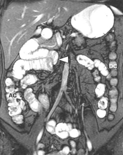 A 37-year-old female patient presented with chronic abdominal pain and was suspected of having irritable bowel syndrome. MR enteroclysis coronal fat-saturated true-FISP image demonstrates the duodenojejunal junction and proximal jejunum loops located on the right-hand side of the abdomen (arrowhead) and the normal position of the ascending colon (AC) and descending colon (DC). All images courtesy of Dr. Giedre Kavaliauskiene.