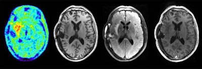 Images du cerveau obtenue par IRM pendant une acquisition TEP: TEP FET, T1, T2 combiné, et T1 après injection de contraste.