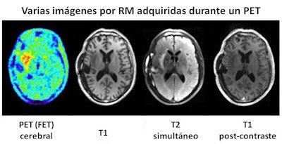 Varias imágenes por RM adquiridas durante un PET