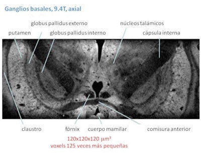 La imagen de ganglios basales obtenida con 9.4 teslas