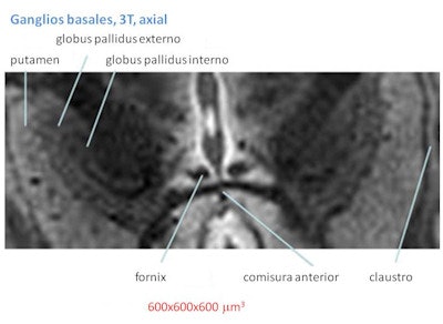 La imagen de ganglios basales obtenida con 3 teslas (arriba) no logra la claridad, definición y contraste de la imagen obtenida con 9.4 teslas (abajo).