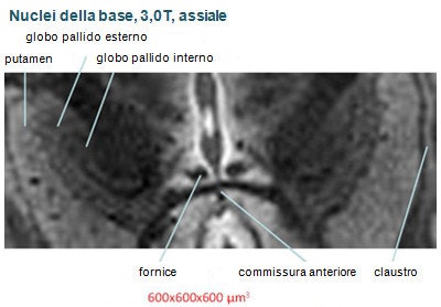 Non c'è confronto fra le immagini dei nuclei della base ottenute a 3,0T (sopra) e 9,4T (sotto), in termini sia di nitidezza e definizione che di contrasto.