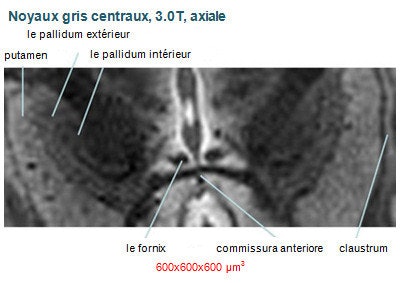 L'image des noyaux gris centraux obtenue à 3 tesla (ci-dessus) est loin de la qualité de l'image obtenue à 9.4 tesla (ci-dessous).