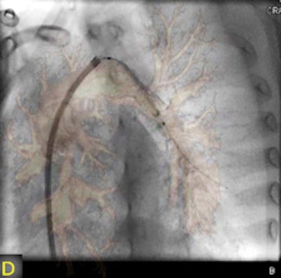 Forty-year-old woman with transposition of the great arteries, Senning operation. Now total superior vena cava obstruction (arrow), venous drainage over large azygos vein (star). Implantation of a stent in the upper venous baffle after needle-perforation, 3D-guided (C+D).