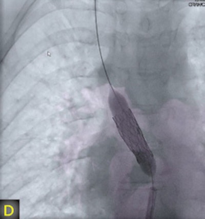 A 6-year-old boy with transposition of the great arteries and arterial switch operation, Lecompte maneuver, patch enlargement of the central pulmonary arteries two years ago, former stent in the right pulmonary branch (star). Maximum intensity projection (MIP) picture B. Now balloon dilatation of peripheral pulmonary arteries stenosis, 3D-guided (D). All images courtesy of Dr. Martin Glöckler.