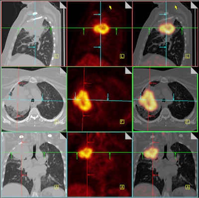 PET/CT for non-small cell lung cancer