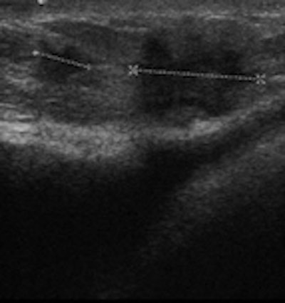 Left: Normal bulge of contour of breast implant on ultrasound. Middle: Benign lesion in breast parenchyma of augmented woman. Right: Malignant lesion in breast parenchyma of augmented woman.