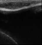 Benign lesion