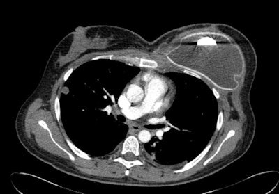 CT scan shows tissue expander in left breast of a woman with breast cancer and pulmonary metastasis.