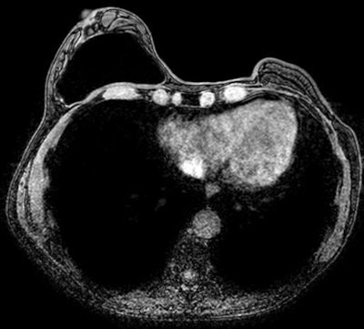 Normal breast implant visualized by axial silicone-suppression MRI sequence. All images courtesy of Dr. Sergi Juanpere.