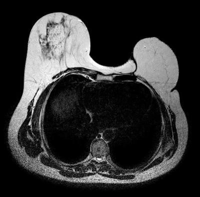 Axial T2-weighted image of breast surgical reconstruction by transverse rectus abdominis musculocutaneous (TRAM) flaps.