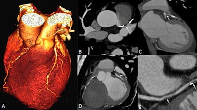 Prospectively ECG-triggered coronary CT angiography of a 61-year-old man with chest pain. 3D-volume-rendered reconstruction shows heavily calcified coronary arteries (A). Multiplanar reformations of the left ascending coronary artery (B and C) and the right coronary artery (D) revealed multiple coronary artery stenoses of greater than 50%. Curved multiplanar reconstruction of the circumflex artery shows a soft and mixed plaque leading to a luminal narrowing of approximately 50%. All images courtesy of of Drs. Christian Fink and Thomas Henzler.