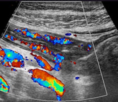 Additional color Doppler images show hyperermia of the bowel.