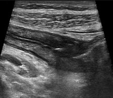 Cross-sectional (left) and longitudinal (right) images of the terminal ileum show thickened bowel wall and inflammatory echogenic fat in a young female patient with acute Crohn's disease of the terminal ileum. All images courtesy of Dr. Stephanie Wilson.