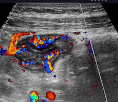 Hyperemia of the bowel